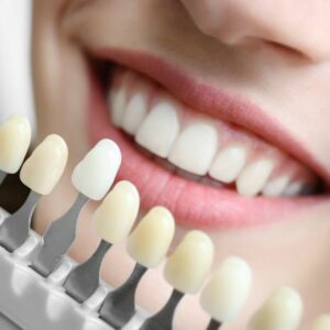 teeth whitening cost