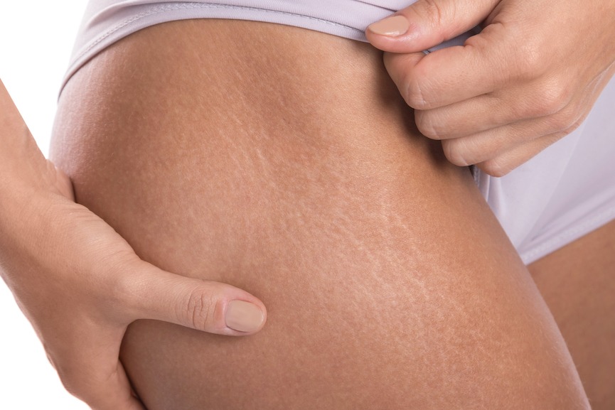 Birth Mark Removal Treatment In Guwahati