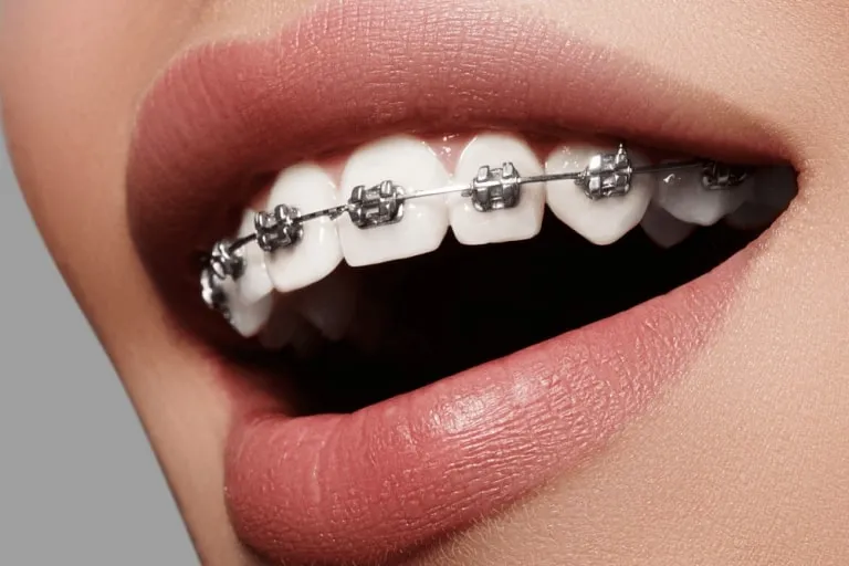 Dental Braces in Islamabad