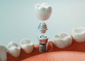 Dental Implants in Dubai