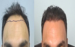 PRP Hair Treatment in Riyadh