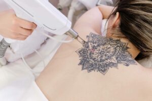 Picosure Tattoo Removal in Dubai