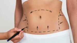 Liposuction Surgery in Dubai