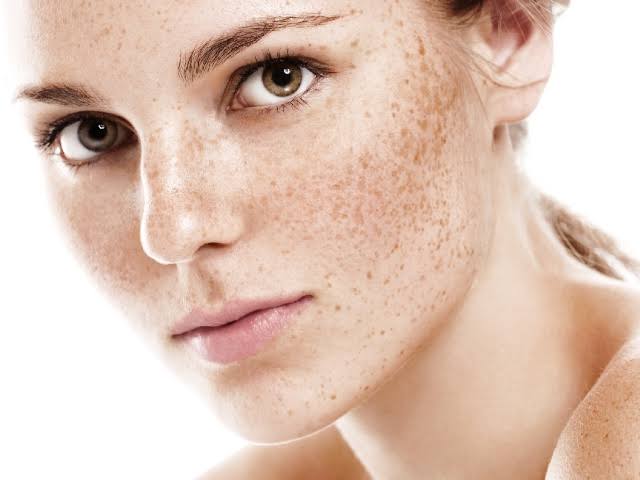 Melasma Treatment in Dubai