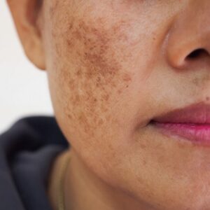 Melasma Treatment in Dubai Discover the Best Solutions for Clear, Even-Toned Skin