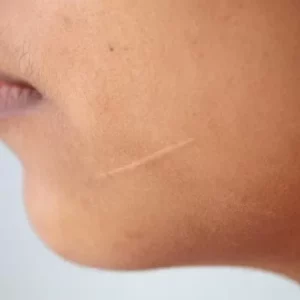 Scar Removal in Islambaad