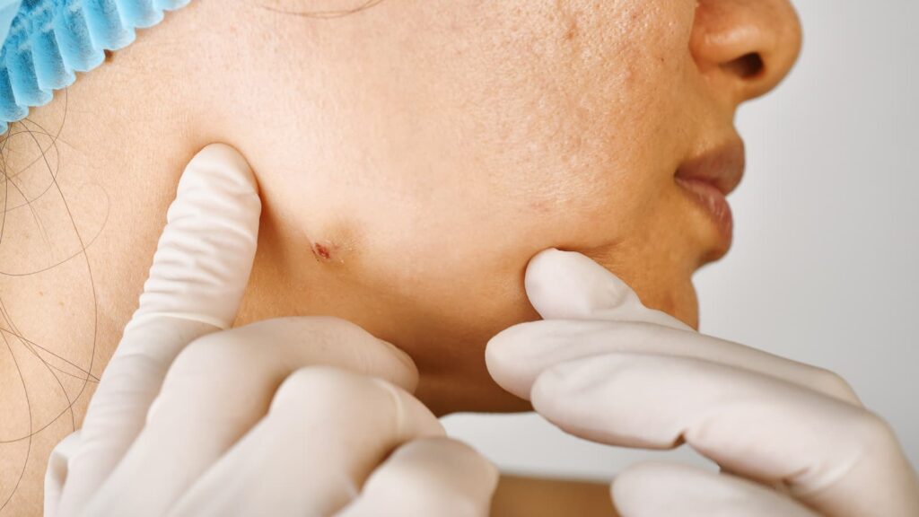 acne scar treatment dermatologist