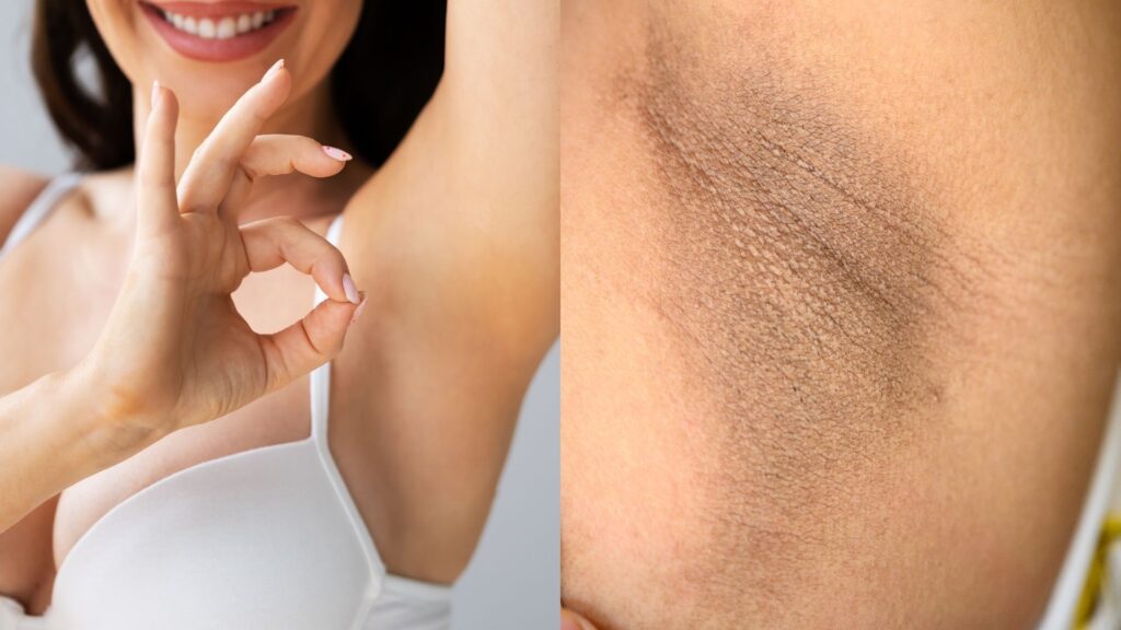 dark underarms treatment dermatologist