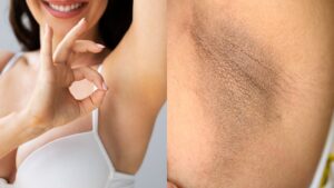 dark underarms treatment dermatologist
