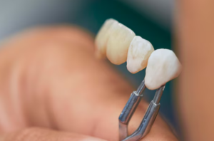 dental crowns glendale az