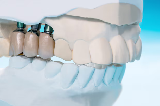 dental implants near macon ga