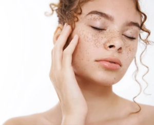 Melasma Treatment in Dubai