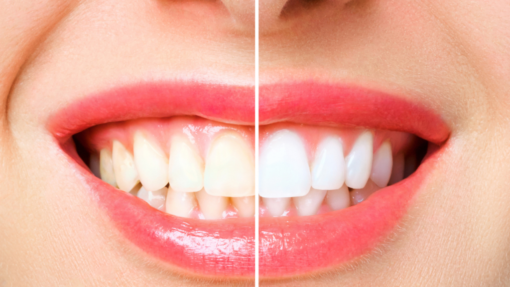 Teeth Whitening