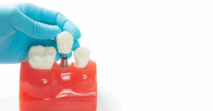 Dental Implants jackson tn