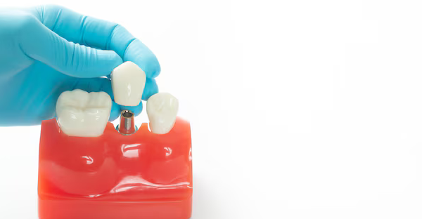 Dental Implants jackson tn