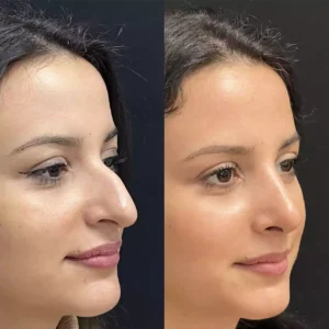 rhinoplasty in dubai
