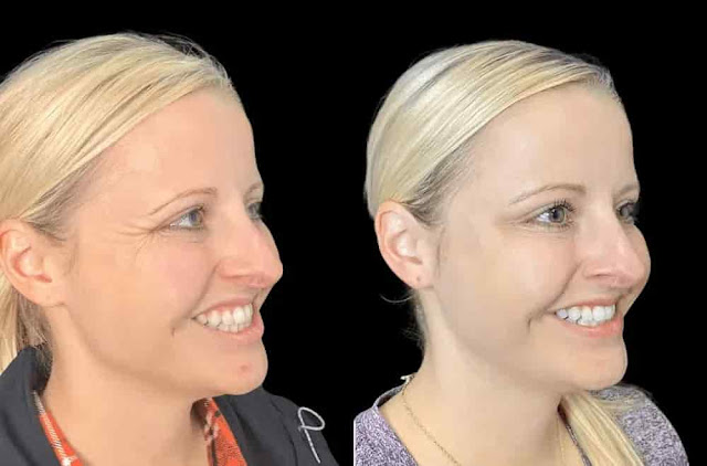 Smooth Fine Lines at the Best Aesthetic Clinic in Dubai for Botox