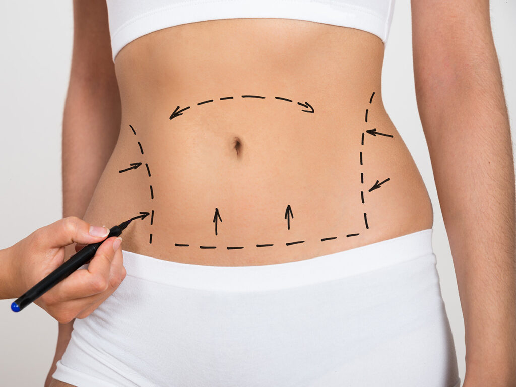 Liposuction in Islamabad