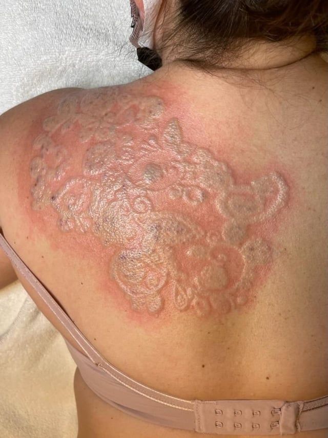 Recognize Minor Signs of Injury After Laser Tattoo Removal
