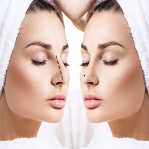 Rhinoplasty in Islamabad