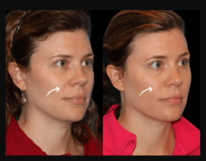 sculptra fillers