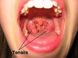 Tonsillitis in Children