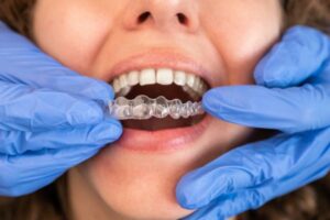 Invisalign Aberdeen