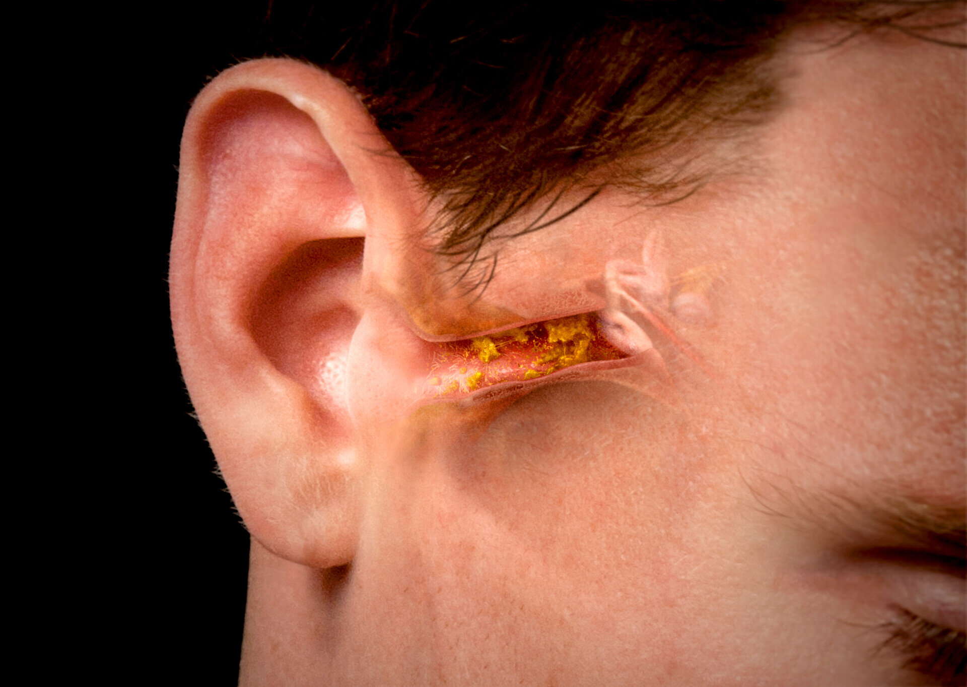 Earwax Buildup