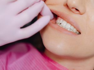 teeth whitening sensitive teeth