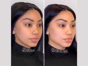 Thread Lifts for Brow Lifting: Achieving a Youthful Expression at the Best Aesthetic Clinics in Dubai