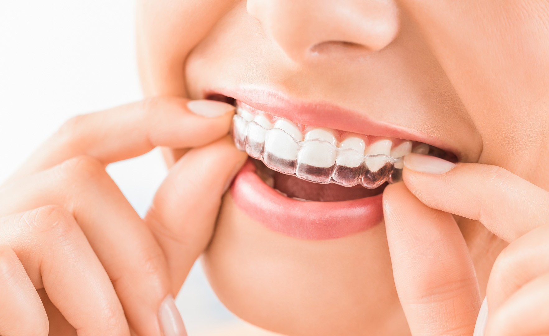 Invisalign Services in Conshohocken