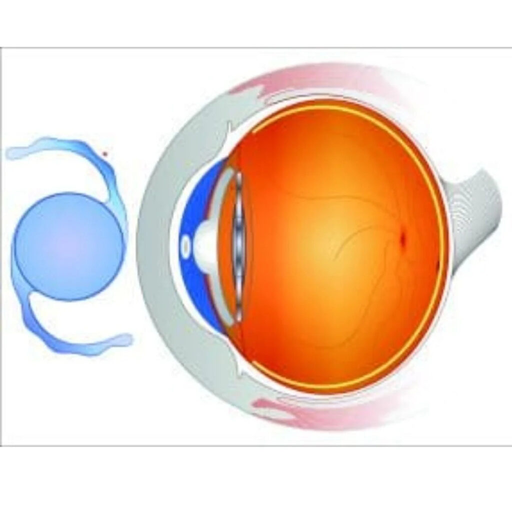 refractive lens exchange cost UK