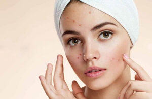 Acne Treatment Dubai