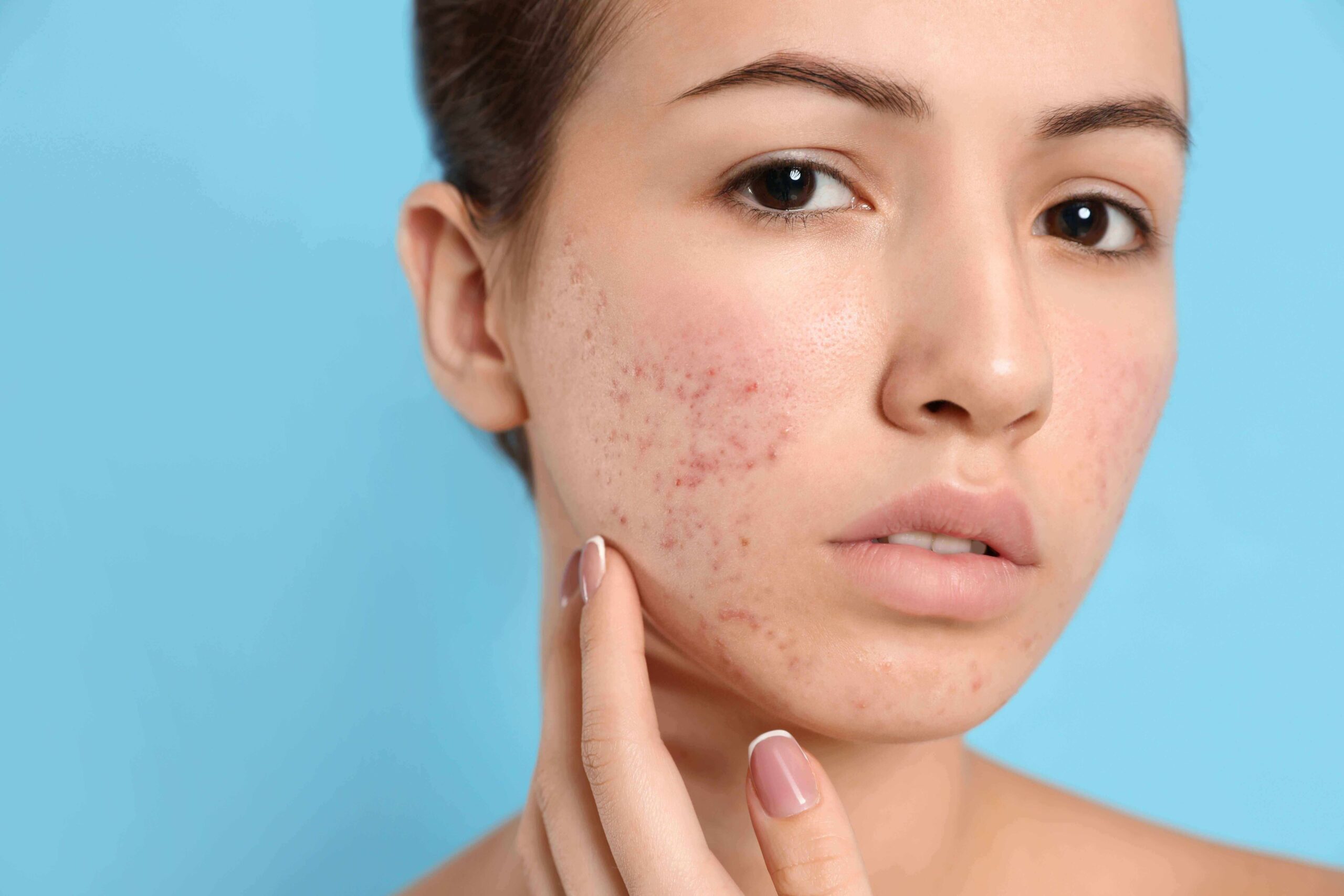 Acne Treatment Dubai