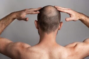 Advanced Crown Hair Transplant Techniques