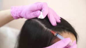Best PRP Hair Treatment in Dubai