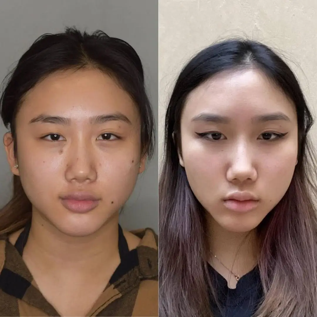 Buccal fat removal