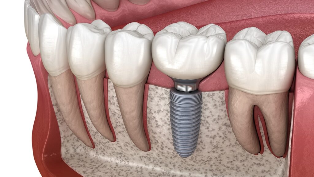 Can I Get Dental Implants in Dubai Without Bone Grafting—What Are My Options
