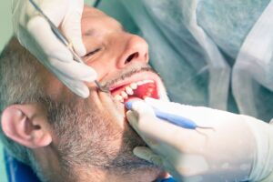 علاج جذور الأسنان في الإمارات