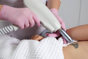 Does Laser Tattoo Removal Work on All Colors