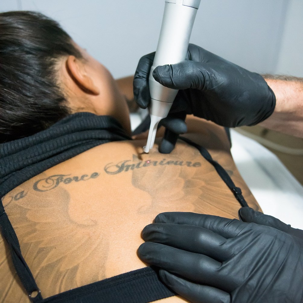 Fast and Safe Tattoo Removal Solutions