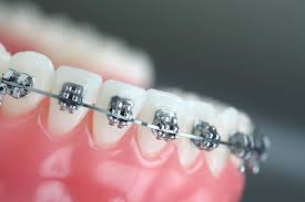 Orthodontics Market