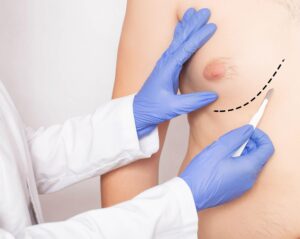 Gynecomastia treatment in Islamabad