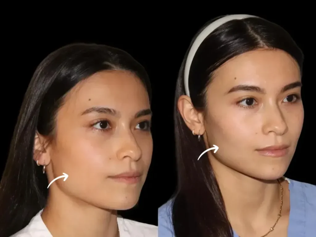 Sculptra Fillers in dubai