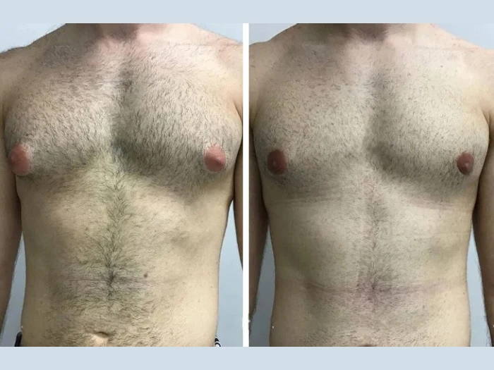 Patient Reviews of the Best Doctors in Dubai for Gynecomastia