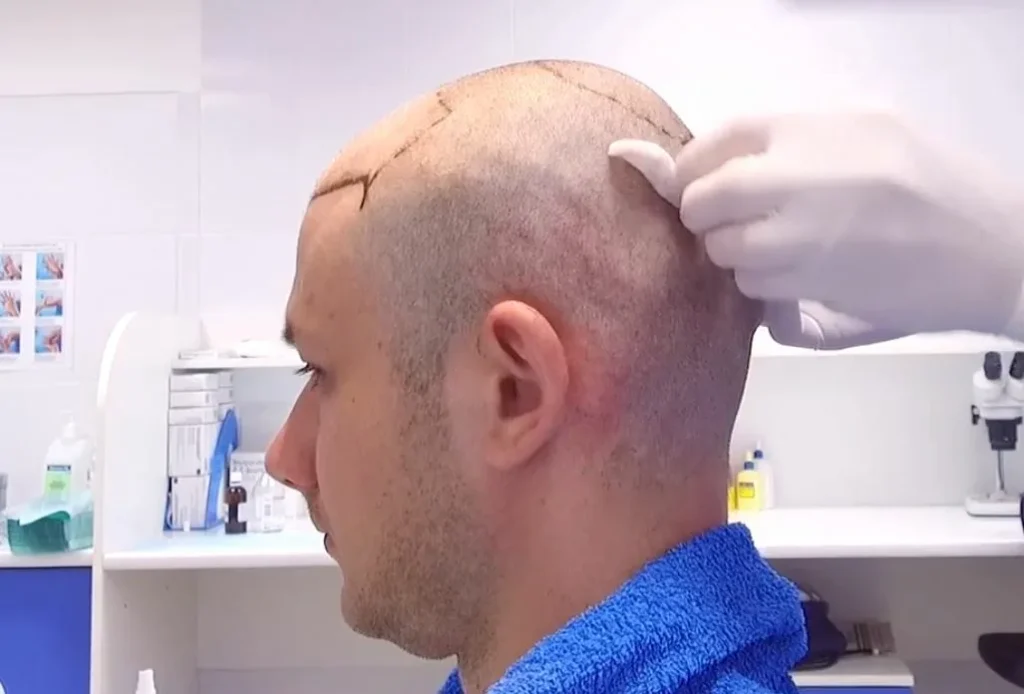 زراعة الشعر في الإمارات العربية المتحدة