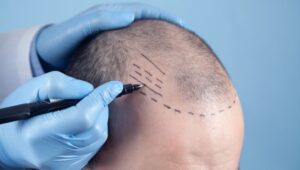 Hair Transplant in Dubai