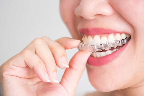 Invisalign Braces Treatment Cost in Dubai
