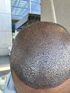 Is Hair Transplant Affordable