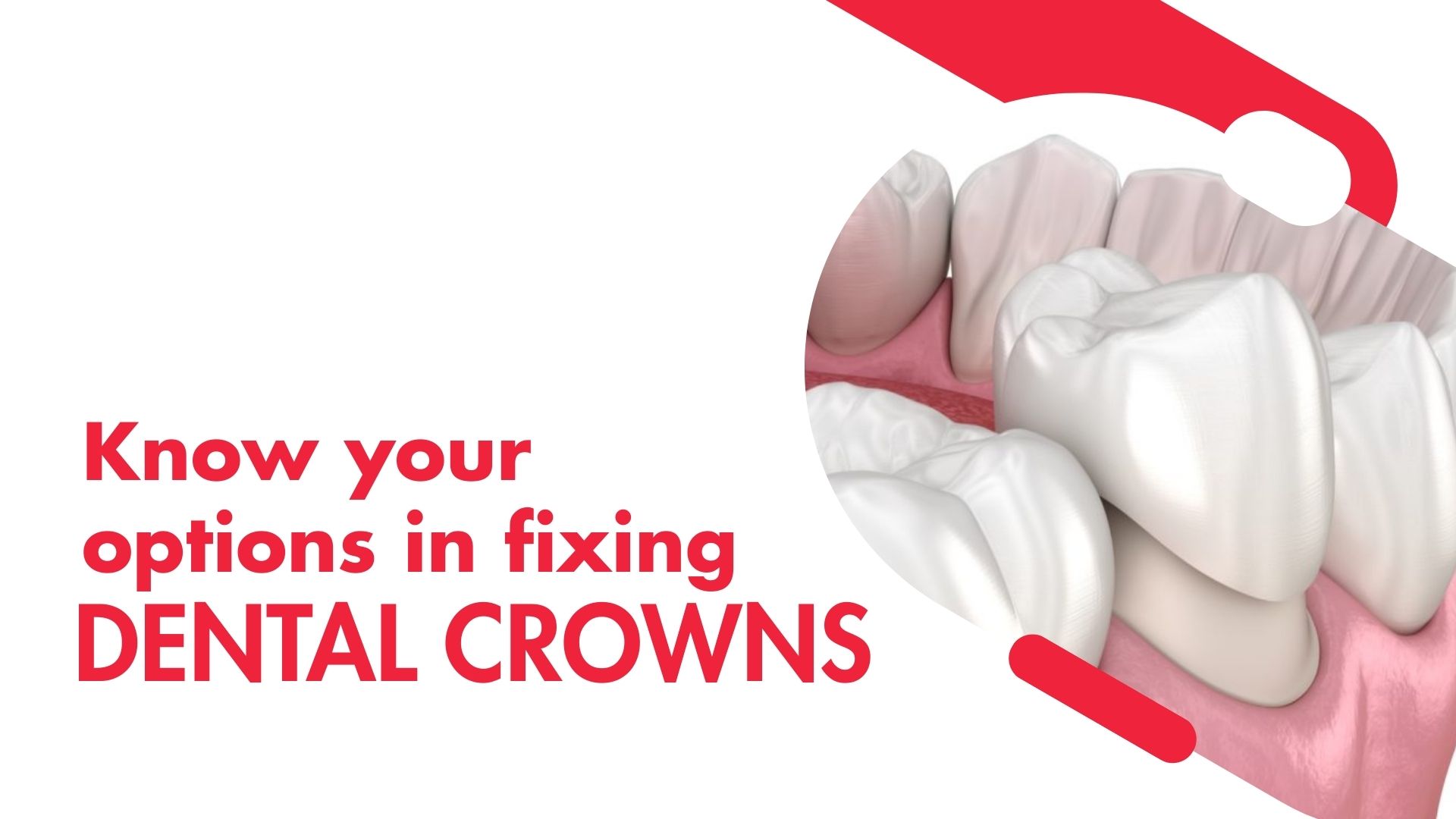 Dental Crown Cost in London